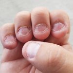 Terrible nails after biting